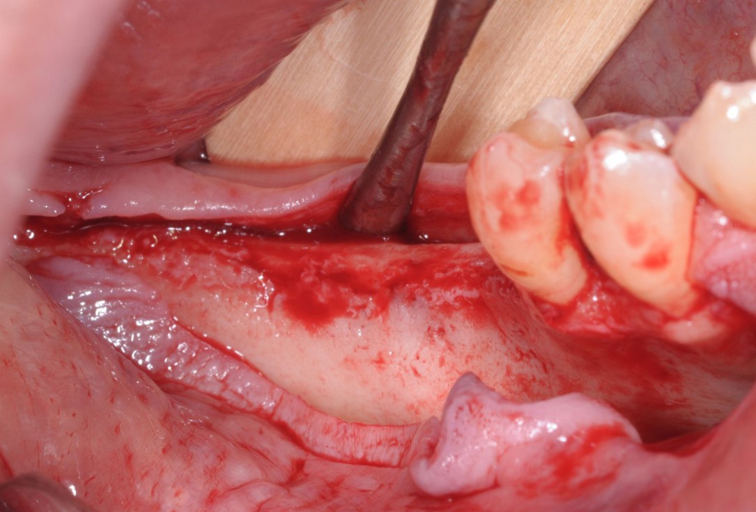 Three-dimensional augmentation with maxgraft® cortico - Dr. R. Würdinger