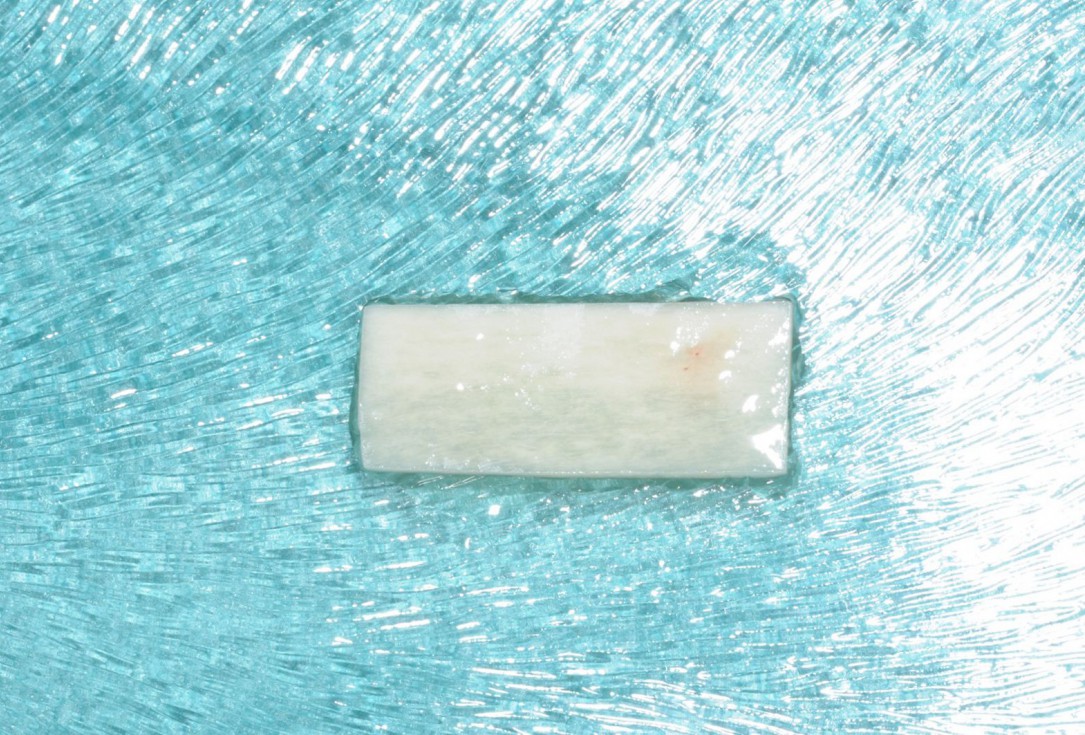 Three-dimensional augmentation with maxgraft® cortico - Dr. R. Würdinger