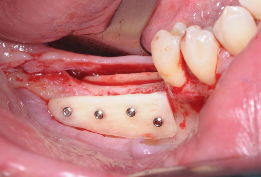 Three-dimensional augmentation with maxgraft® cortico - Dr. R. Würdinger