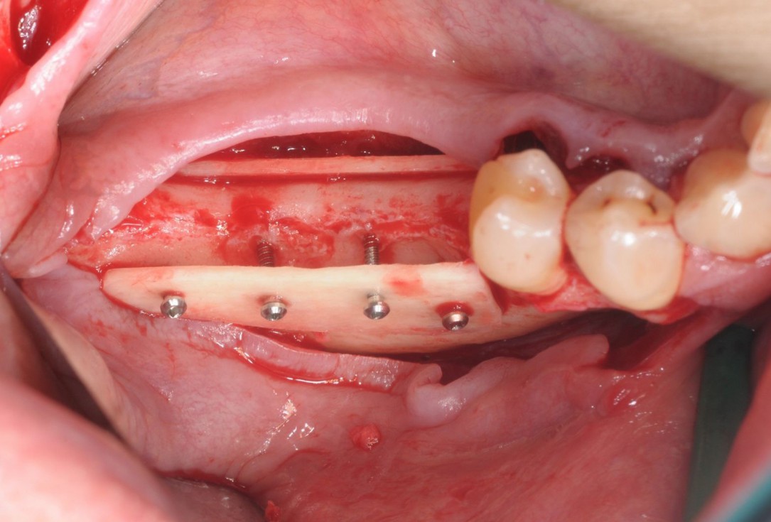 Three-dimensional augmentation with maxgraft® cortico - Dr. R. Würdinger