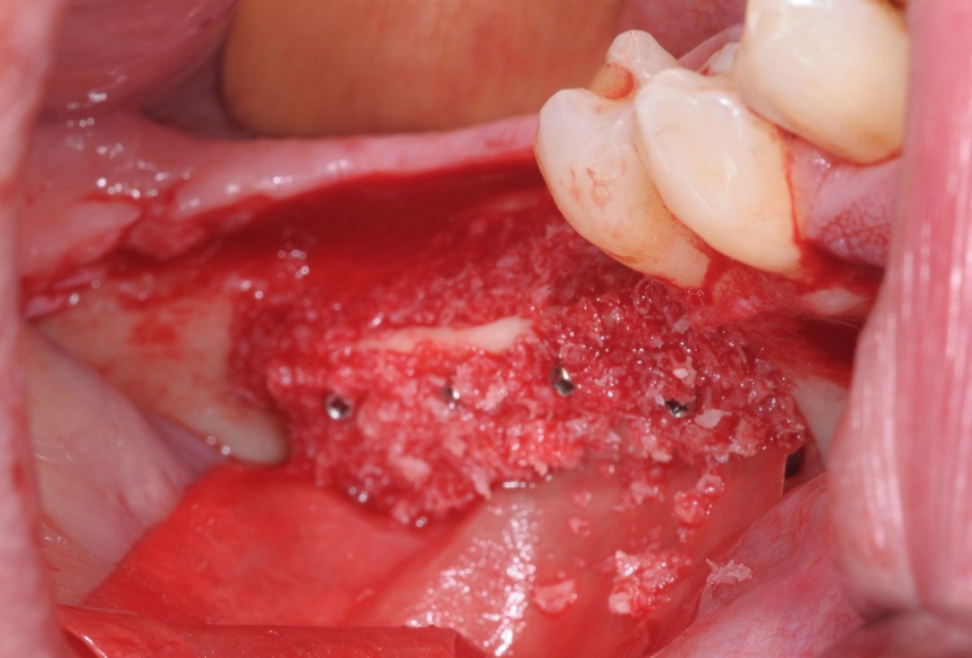 Three-dimensional augmentation with maxgraft® cortico - Dr. R. Würdinger