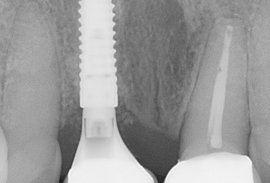 Immediate implant placement and regeneration of ridge using an allograft bone ring and Jason® membrane - Dr. Miller and Korn